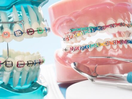 mini implante dentário
