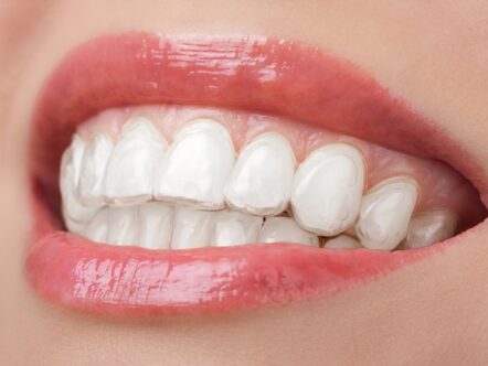 Clareamento dental whiteness perfect