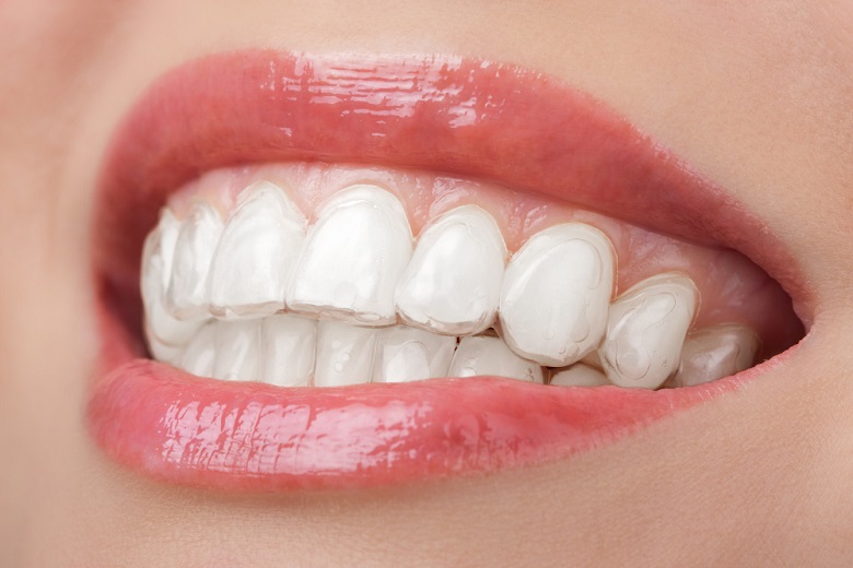 Clareamento dental whiteness perfect