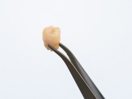Tweezer holding old removed crack wisdom tooth in mouth isolated