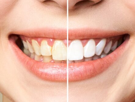 Clareamento dental prejudica o esmalte dos dentes