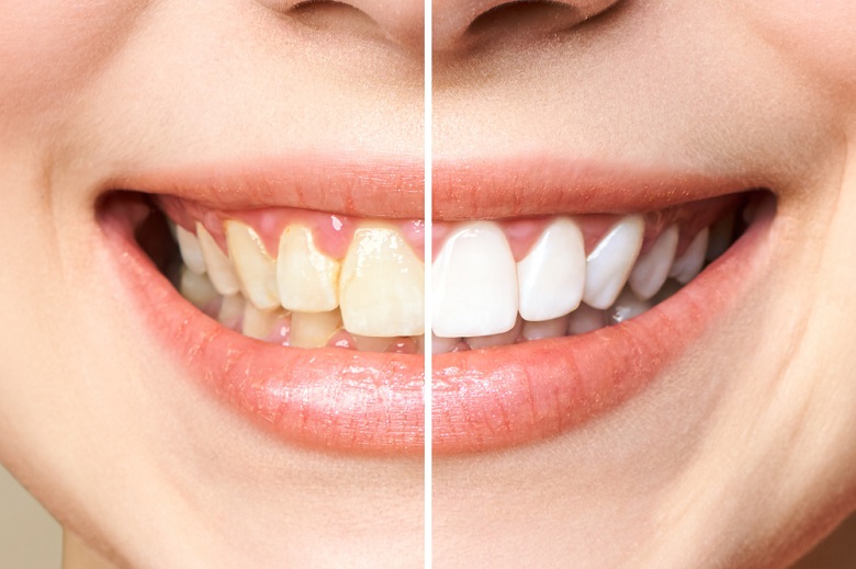 Clareamento dental prejudica o esmalte dos dentes