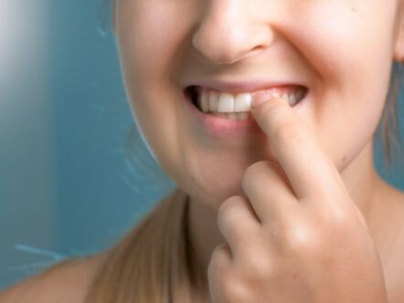 Clareamento de dente desvitalizado