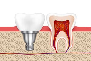 implante dentário