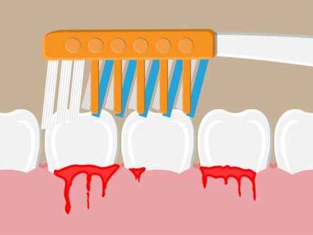 raspagem periodontal